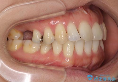 後戻りの再矯正治療と欠損部の補綴治療の治療前