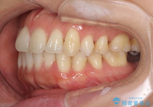 後戻りの再矯正治療と欠損部の補綴治療の治療前