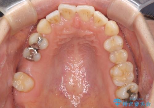後戻りの再矯正治療と欠損部の補綴治療の治療前