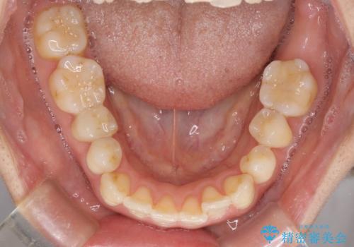 後戻りの再矯正治療と欠損部の補綴治療の治療前