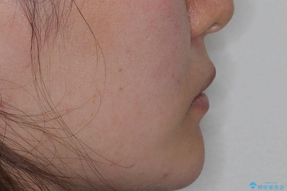 【がたつき・深い噛み合わせでお悩みの方必見】抜歯矯正症例(審美ワイヤー矯正)の治療後(顔貌)