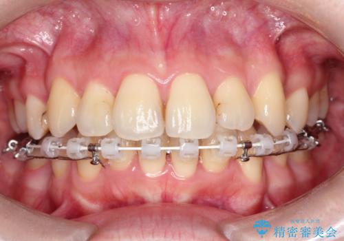 ガタガタの抜歯矯正を裏側ワイヤーを使っての目立たない矯正の治療中