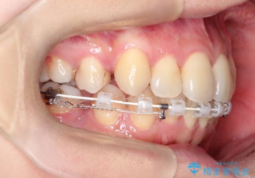 ガタガタの抜歯矯正を裏側ワイヤーを使っての目立たない矯正の治療中