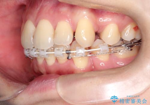 ガタガタの抜歯矯正を裏側ワイヤーを使っての目立たない矯正の治療中