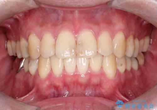 全体的ながたつきをインビザラインで改善の症例 治療後