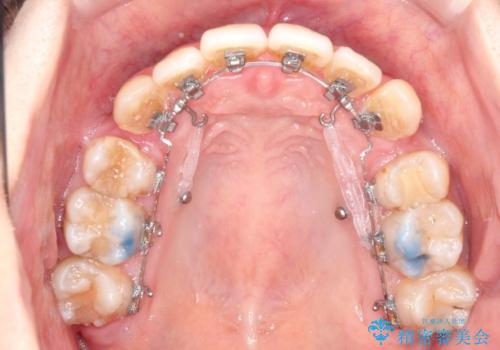 ガタガタの抜歯矯正を裏側ワイヤーを使っての目立たない矯正の治療中