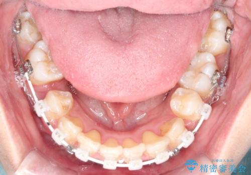 ガタガタの抜歯矯正を裏側ワイヤーを使っての目立たない矯正の治療中