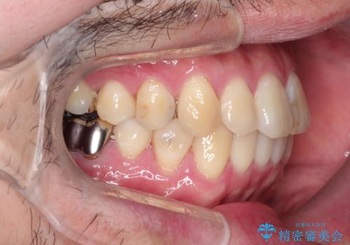 全体的ながたつきをインビザラインで改善の治療後