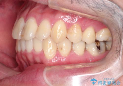 全体的ながたつきをインビザラインで改善の治療後