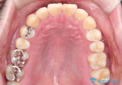 全体的ながたつきをインビザラインで改善の治療後