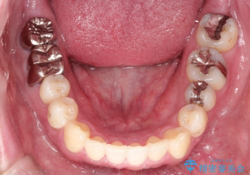 全体的ながたつきをインビザラインで改善の治療後
