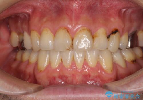むし歯や銀歯が気になる　後戻りの再矯正治療とむし歯治療の症例 治療前