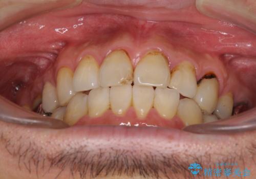 むし歯や銀歯が気になる　後戻りの再矯正治療とむし歯治療の治療前