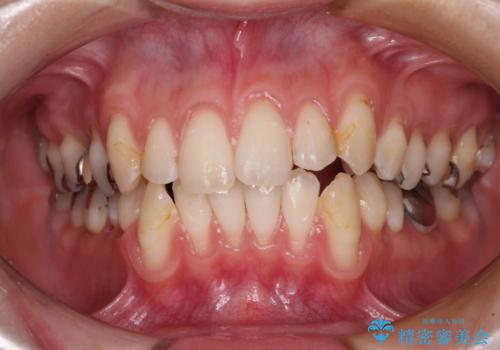 磨きすぎて傷が付くほどの歯根　歯肉移植術による根面被覆の治療前