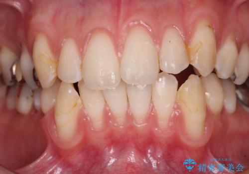 磨きすぎて傷が付くほどの歯根　歯肉移植術による根面被覆の治療前