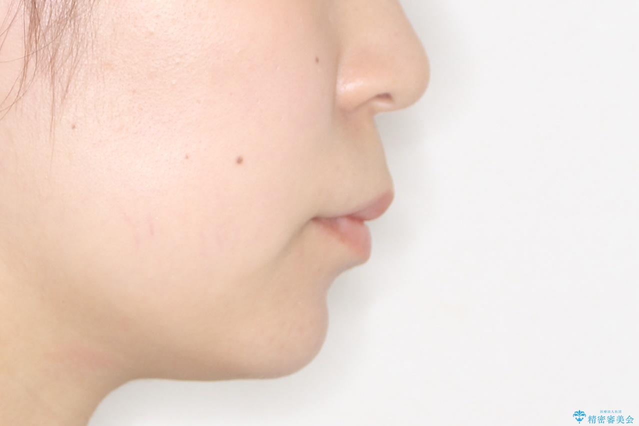 ガタガタの抜歯矯正を裏側ワイヤーを使っての目立たない矯正の治療前(顔貌)