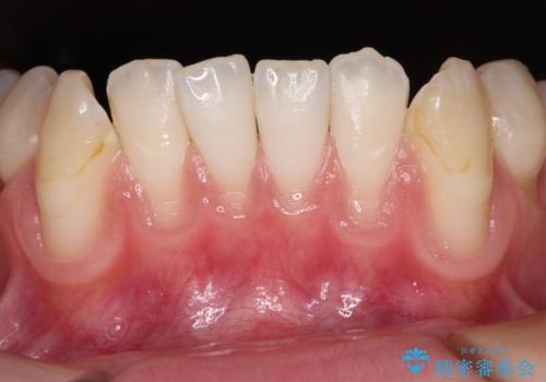 磨きすぎて傷が付くほどの歯根　歯肉移植術による根面被覆の症例 治療前