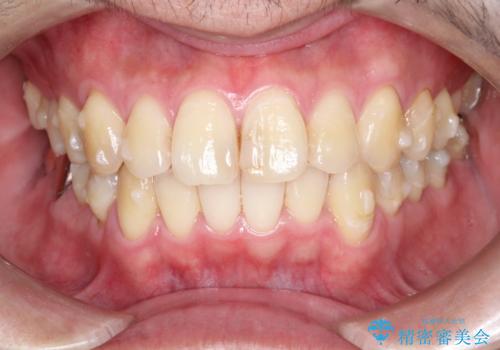 全体的ながたつきをインビザラインで改善の治療中