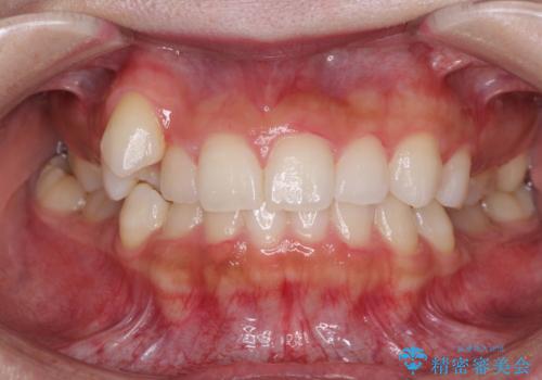 八重歯を改善　目立たないワイヤー装置での矯正治療の治療前