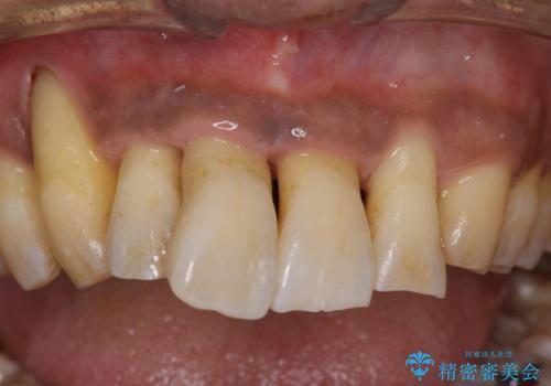 歯周病の初期治療　歯石除去とクリーニングのみでの治療の治療後