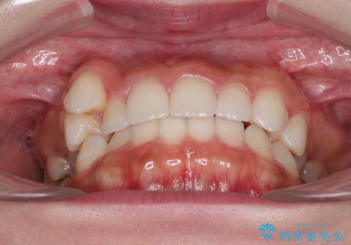 八重歯を改善 目立たないワイヤー装置での矯正治療の治療前