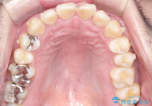 全体的ながたつきをインビザラインで改善の治療中