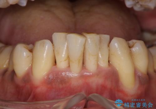 歯周病の初期治療 歯石除去とクリーニングのみでの治療の治療後