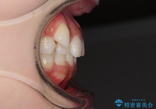 八重歯を改善 目立たないワイヤー装置での矯正治療の治療前