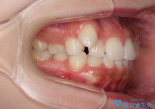 八重歯を改善 目立たないワイヤー装置での矯正治療の治療前