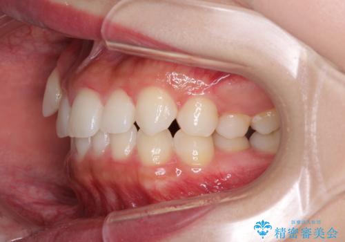 八重歯を改善　目立たないワイヤー装置での矯正治療の治療前