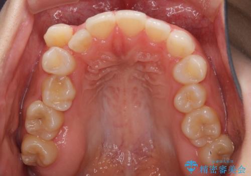 八重歯を改善 目立たないワイヤー装置での矯正治療の治療前