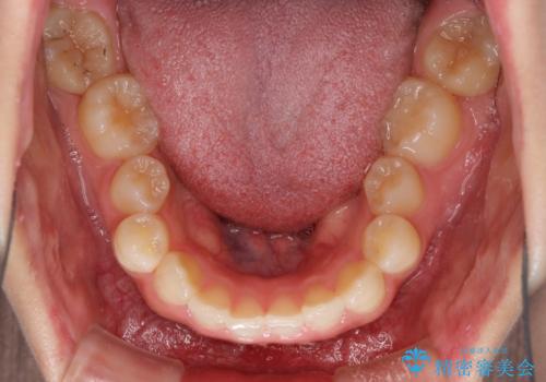 八重歯を改善 目立たないワイヤー装置での矯正治療の治療前