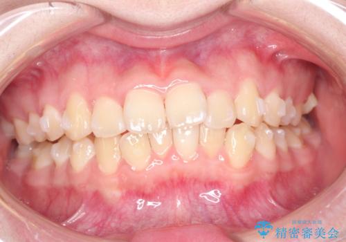 なるべく通院回数を減らして矯正したい インビザラインでのガタガタ矯正の治療中