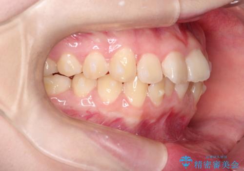 なるべく通院回数を減らして矯正したい インビザラインでのガタガタ矯正の治療中