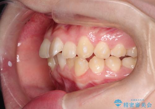 なるべく通院回数を減らして矯正したい インビザラインでのガタガタ矯正の治療中