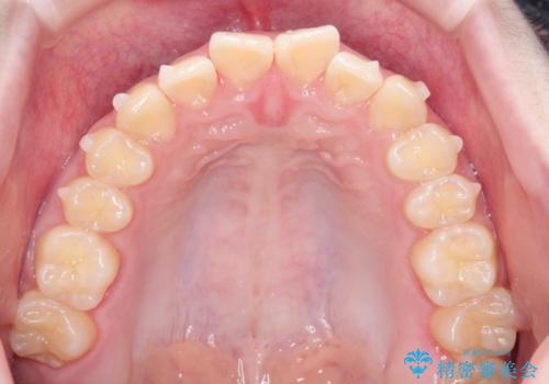 なるべく通院回数を減らして矯正したい インビザラインでのガタガタ矯正の治療中