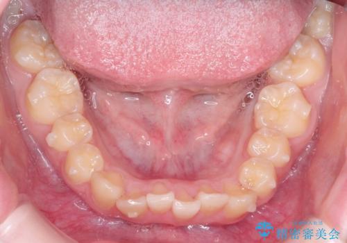 なるべく通院回数を減らして矯正したい インビザラインでのガタガタ矯正の治療中