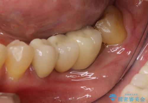 部分矯正してからオールセラミックブリッジの治療前