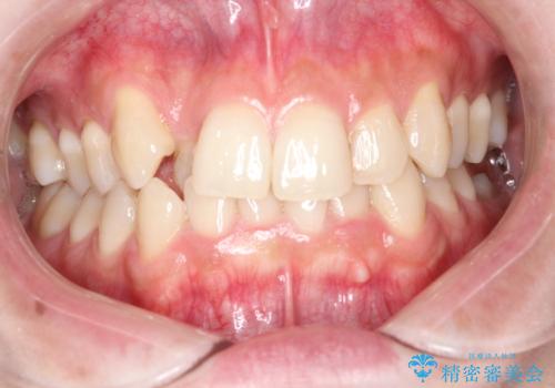 八重歯を抜歯せずに矯正　インビザラインでの症例 治療前