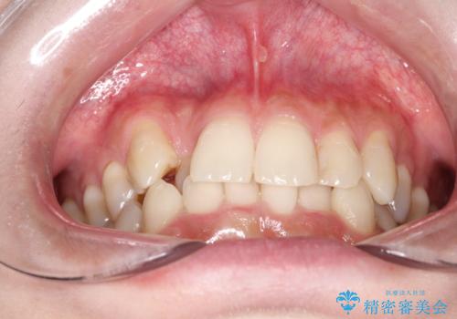 八重歯を抜歯せずに矯正 インビザラインでの治療前