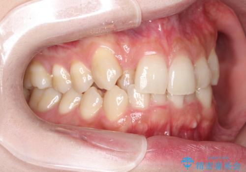 八重歯を抜歯せずに矯正 インビザラインでの治療前
