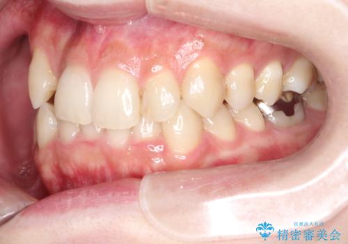 八重歯を抜歯せずに矯正 インビザラインでの治療前