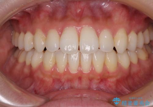 インビザラインで口を閉じやすくの治療中