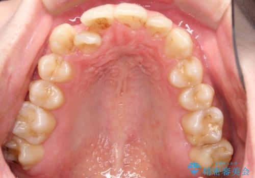 八重歯を抜歯せずに矯正 インビザラインでの治療前