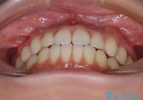 インビザラインで口を閉じやすくの治療中