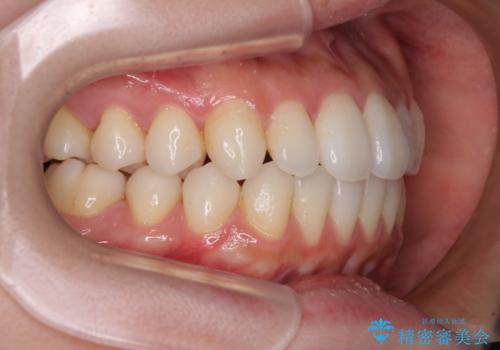 インビザラインで口を閉じやすくの治療中
