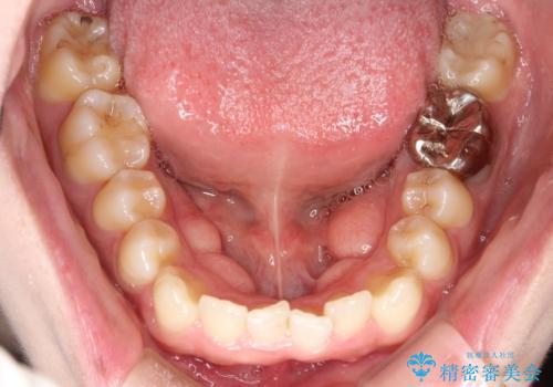 八重歯を抜歯せずに矯正 インビザラインでの治療前