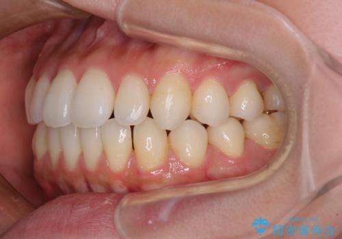 インビザラインで口を閉じやすくの治療中