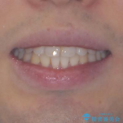 インビザラインで奥歯の咬み合わせと前歯のデコボコを改善の治療後（顔貌）