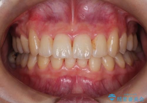 【がたつき・深い噛み合わせでお悩みの方必見】抜歯矯正症例(審美ワイヤー矯正)の治療後